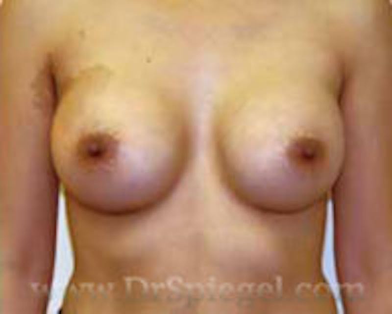 Breast Augmentation Before & After Gallery - Patient 351759 - Image 2