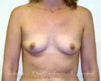 Breast Augmentation Before & After Gallery - Patient 658599 - Image 1