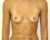 Breast Augmentation Before & After Gallery - Patient 924361 - Image 1