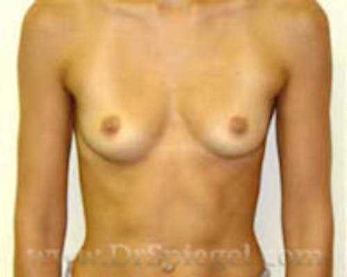 Breast Augmentation Before & After Gallery - Patient 924361 - Image 1