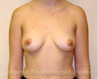 Breast Augmentation Before & After Gallery - Patient 701287 - Image 1
