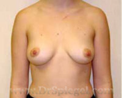 Breast Augmentation Before & After Gallery - Patient 701287 - Image 1