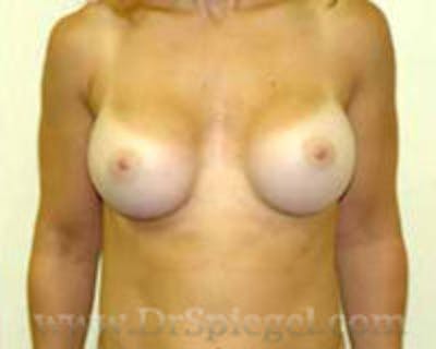 Breast Augmentation Before & After Gallery - Patient 381610 - Image 2