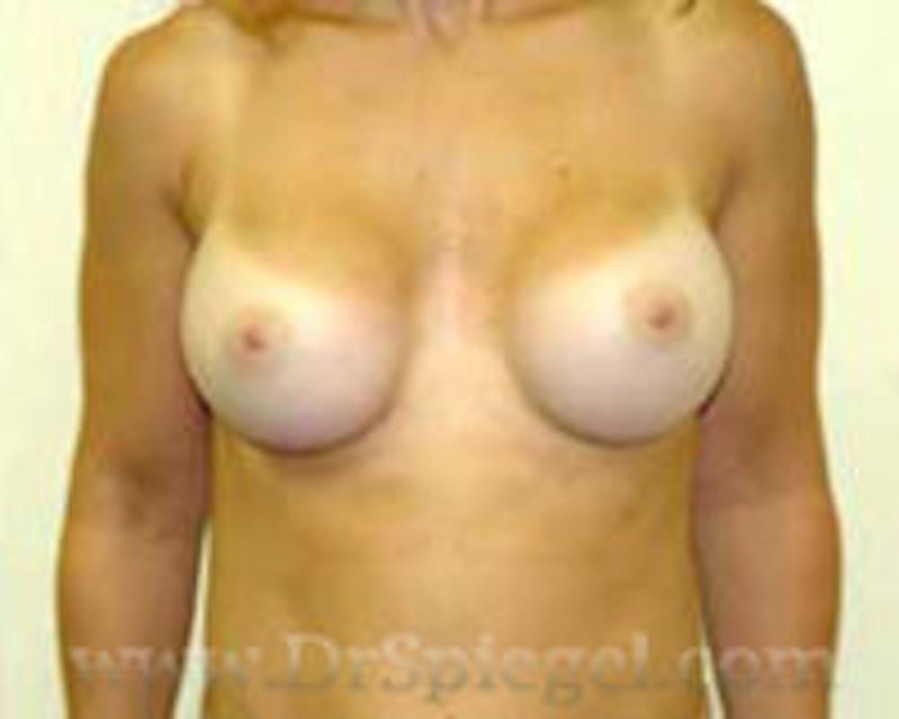 Breast Augmentation