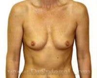 Breast Augmentation Before & After Gallery - Patient 260723 - Image 1