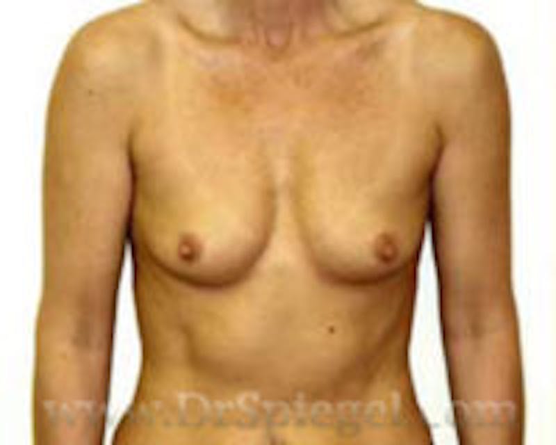 Breast Augmentation Before & After Gallery - Patient 260723 - Image 1