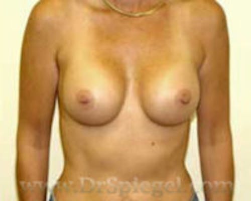 Breast Augmentation Before & After Gallery - Patient 260723 - Image 2