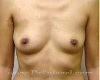 Mommy Makeover Before & After Gallery - Patient 424314 - Image 1