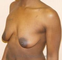 Breast Lift Before & After Gallery - Patient 378954 - Image 1