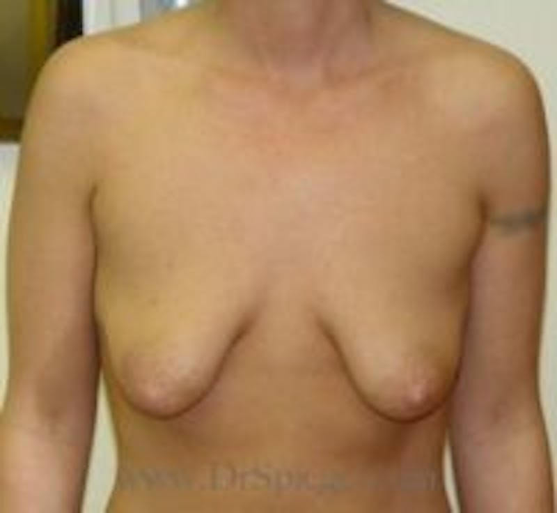 Breast Lift Before & After Gallery - Patient 243252 - Image 1