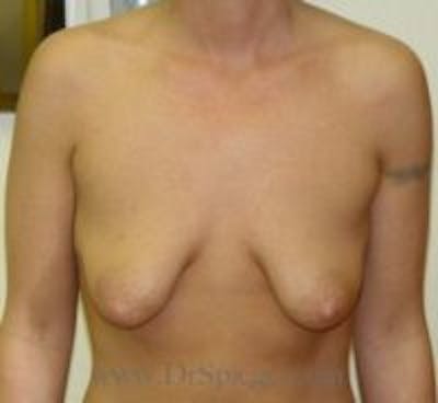 Breast Lift Before & After Gallery - Patient 243252 - Image 1