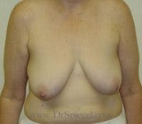 Breast Lift Before & After Gallery - Patient 249803 - Image 1