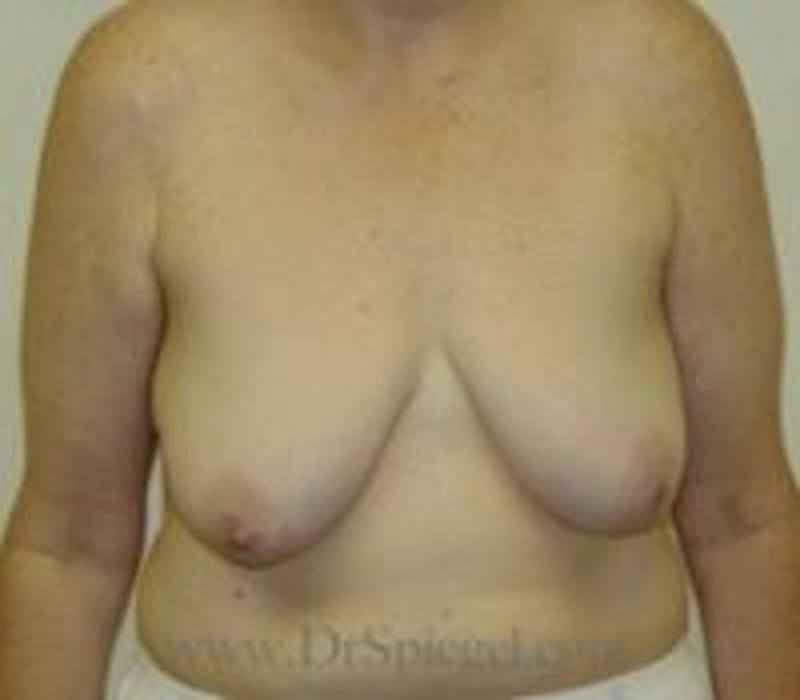 Breast Lift Before & After Gallery - Patient 249803 - Image 1