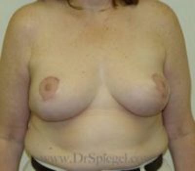 Breast Lift Before & After Gallery - Patient 249803 - Image 2