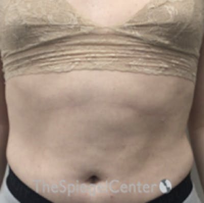 Liposuction Before & After Gallery - Patient 421610 - Image 1