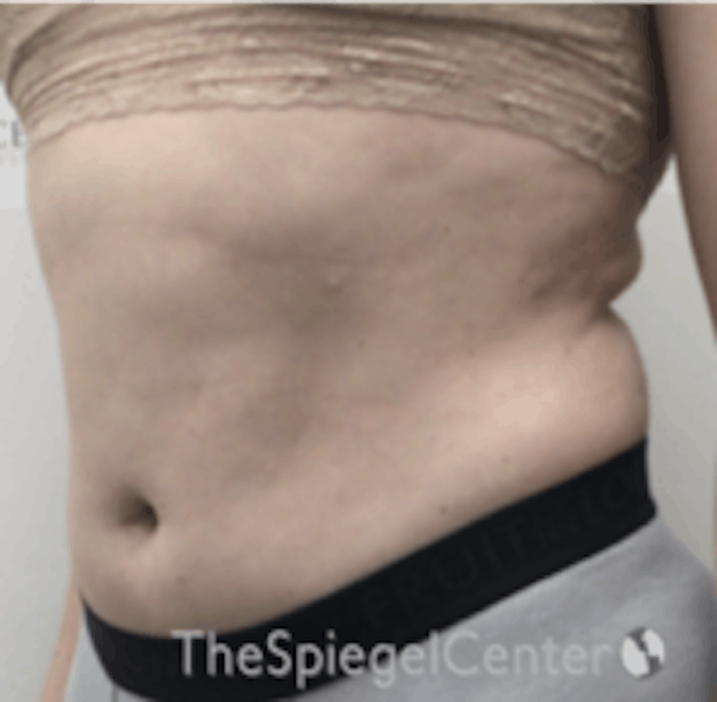 Liposuction Before & After Gallery - Patient 421610 - Image 3