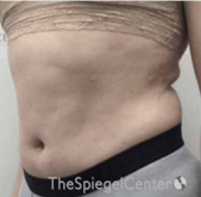 Liposuction Before & After Gallery - Patient 421610 - Image 3