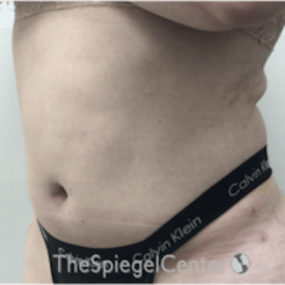 Liposuction Before & After Gallery - Patient 421610 - Image 4