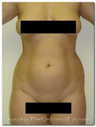 Liposuction Before & After Gallery - Patient 154729 - Image 1