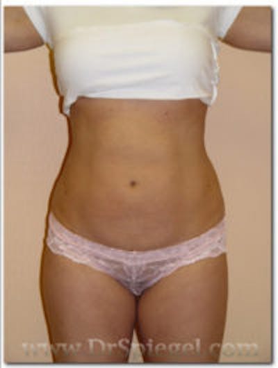 Liposuction Before & After Gallery - Patient 154729 - Image 2