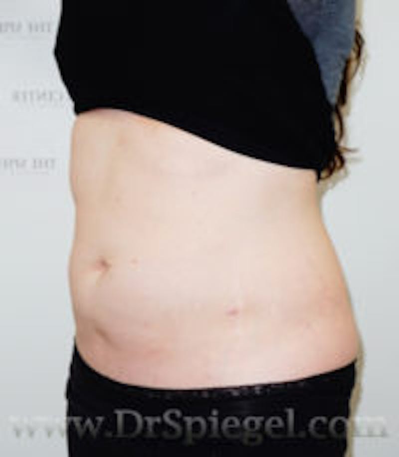 Liposuction Before & After Gallery - Patient 921195 - Image 2