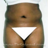 Liposuction Before & After Gallery - Patient 267671 - Image 1