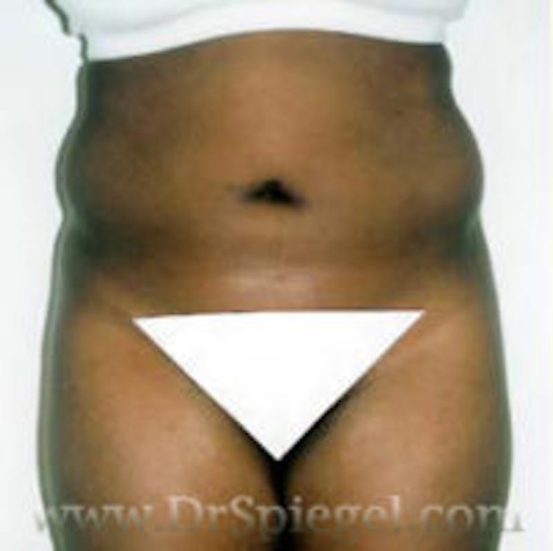 Liposuction Before & After Gallery - Patient 267671 - Image 1