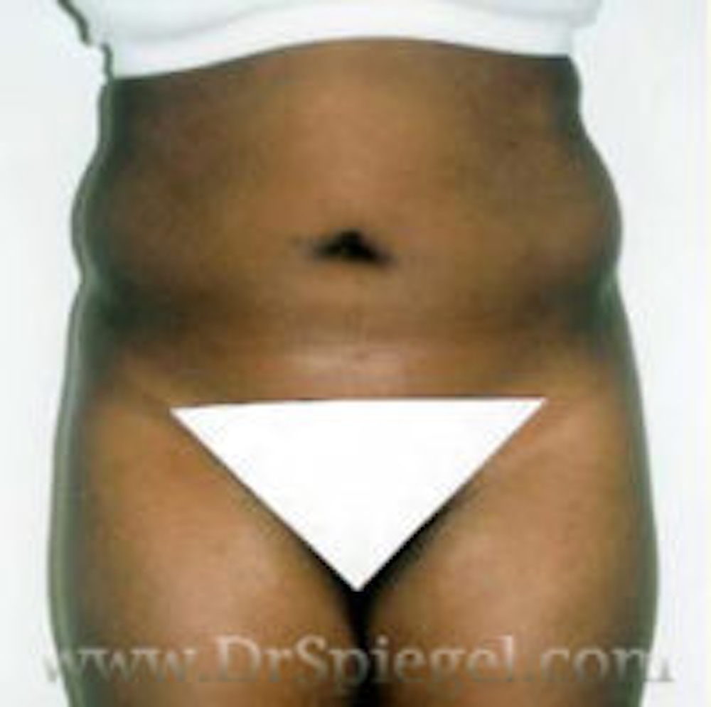 Liposuction
