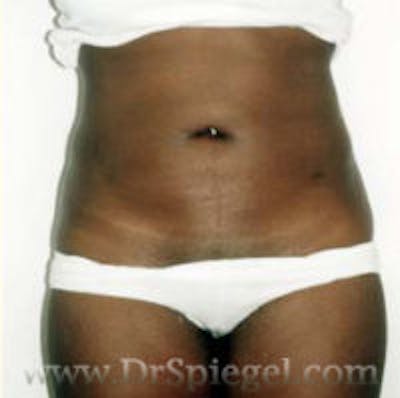 Liposuction Before & After Gallery - Patient 267671 - Image 2