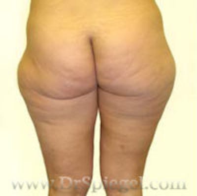 Liposuction Before & After Gallery - Patient 330631 - Image 1