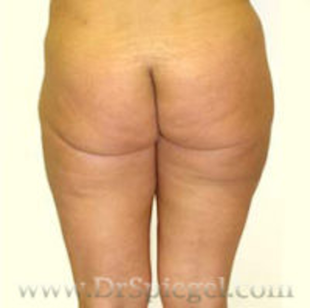 Liposuction