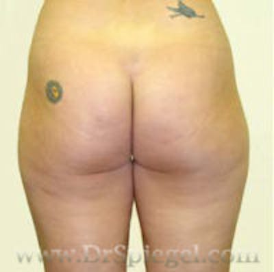 Liposuction Before & After Gallery - Patient 700689 - Image 1