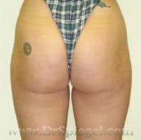Mommy Makeover Before & After Gallery - Patient 329308 - Image 2