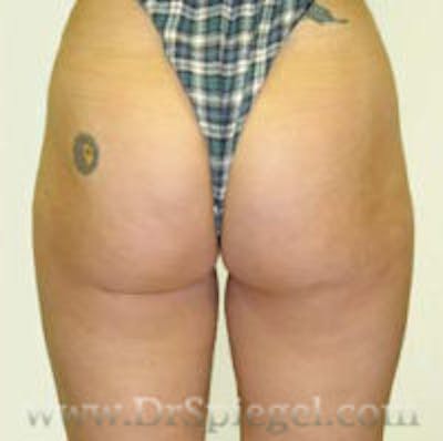 Liposuction Before & After Gallery - Patient 700689 - Image 2