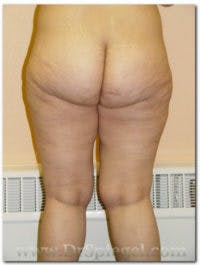 Liposuction Before & After Gallery - Patient 118353 - Image 2