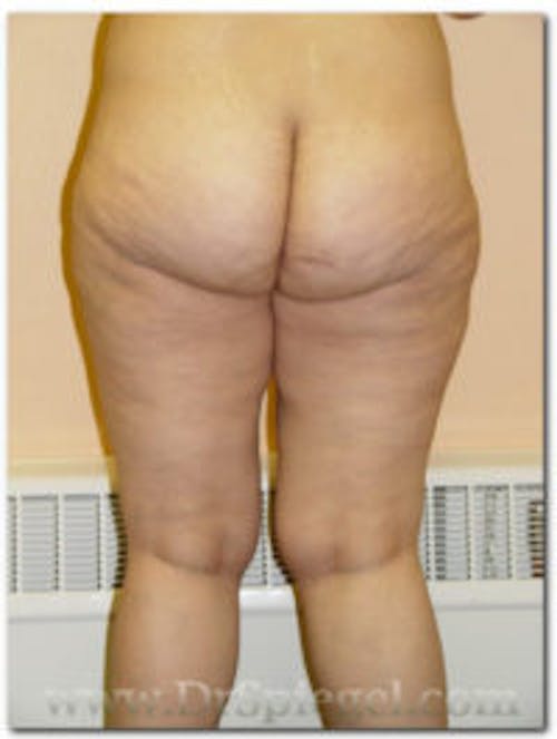 Liposuction Before & After Gallery - Patient 118353 - Image 2