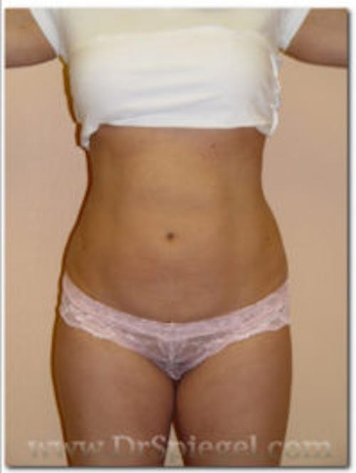 Mommy Makeover Before & After Gallery - Patient 408804 - Image 2