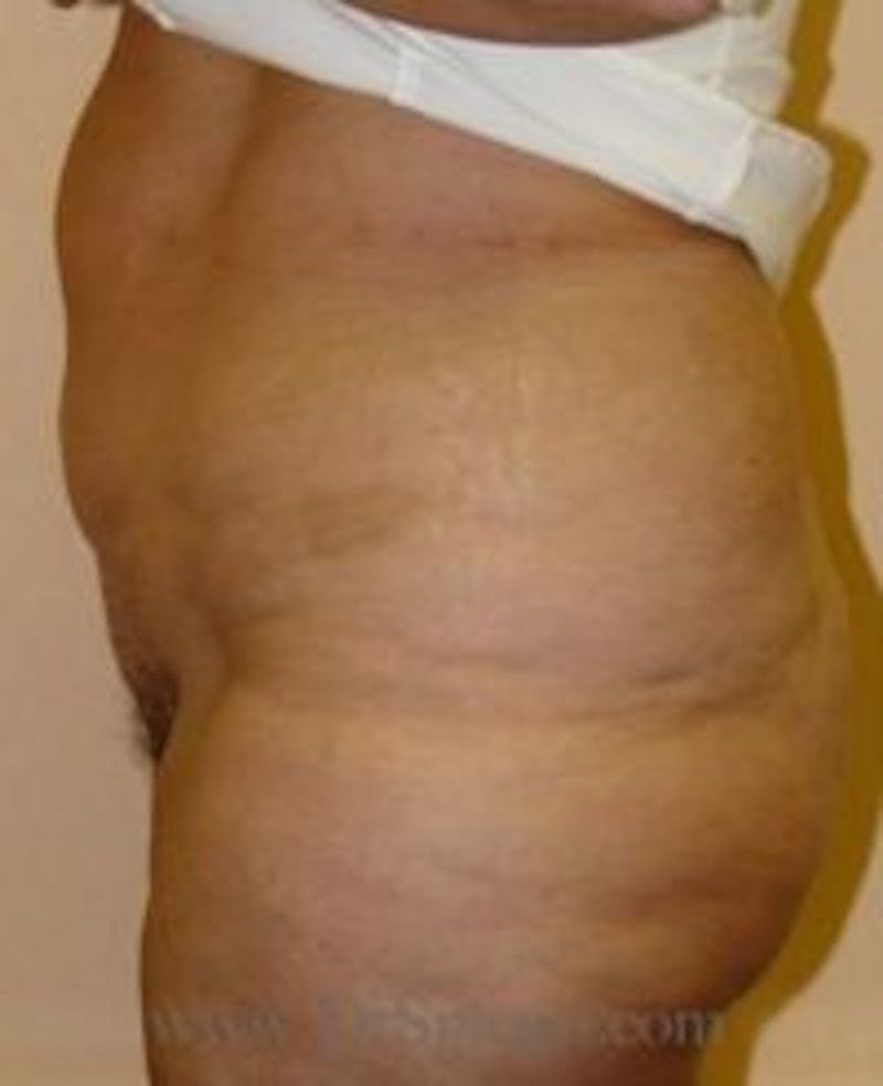 Tummy Tuck Before & After Gallery - Patient 300685 - Image 2