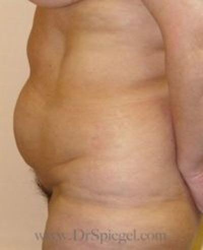 Tummy Tuck Before & After Gallery - Patient 300685 - Image 1