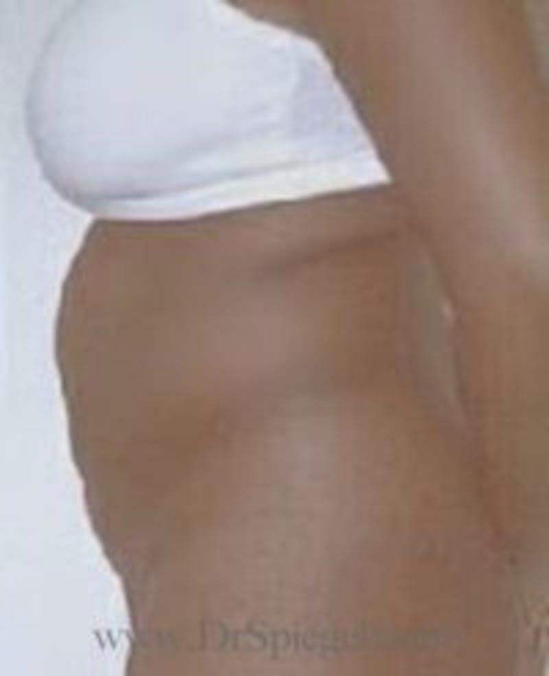 Tummy Tuck Before & After Gallery - Patient 186961 - Image 1