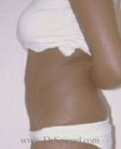 Tummy Tuck Before & After Gallery - Patient 186961 - Image 2