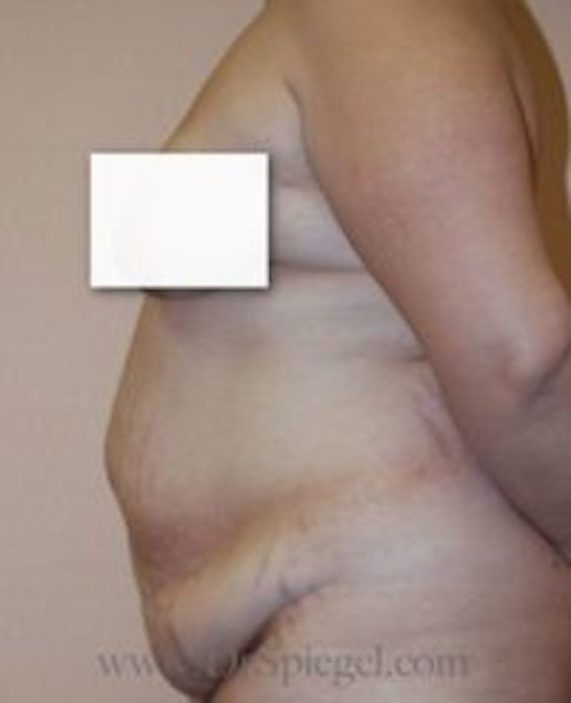 Tummy Tuck Before & After Gallery - Patient 308770 - Image 1