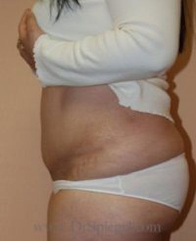 Tummy Tuck Before & After Gallery - Patient 308770 - Image 2