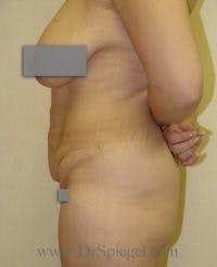 Mommy Makeover Before & After Gallery - Patient 157994 - Image 1