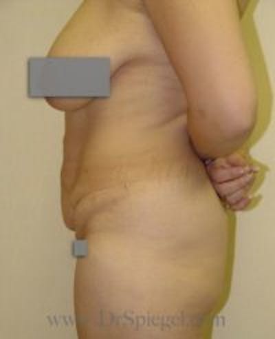 Tummy Tuck Before & After Gallery - Patient 168852 - Image 1