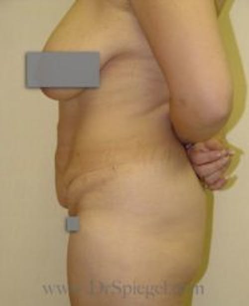 Mommy Makeover Before & After Gallery - Patient 157994 - Image 1