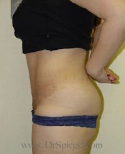 Tummy Tuck Before & After Gallery - Patient 168852 - Image 2