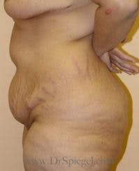 Mommy Makeover Before & After Gallery - Patient 156923 - Image 1