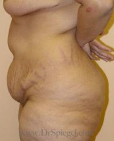 Tummy Tuck Before & After Gallery - Patient 156196 - Image 1