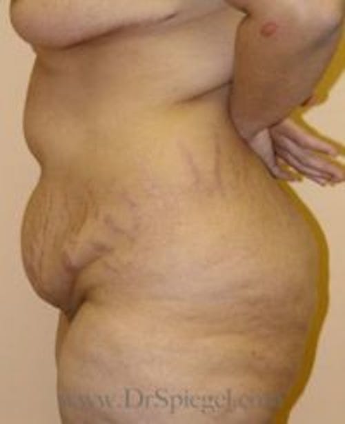 Mommy Makeover Before & After Gallery - Patient 156923 - Image 1